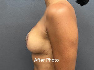 Breast Reduction