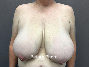 Breast Reduction