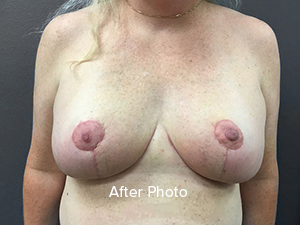 Breast Reduction