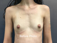 Breast Augmentation