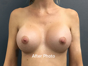 Breast Augmentation