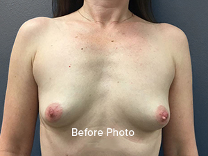 Breast Augmentation