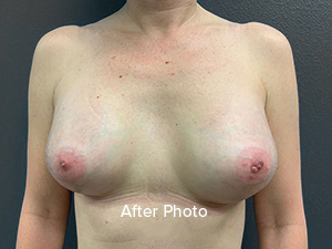 Breast Augmentation