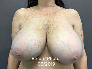 Breast Reduction