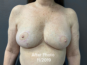 Breast Reduction