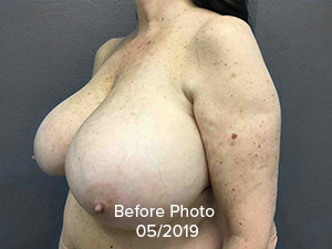 Breast Reduction