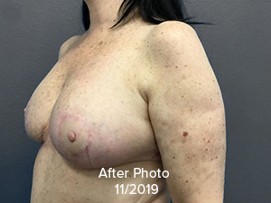 Breast Reduction