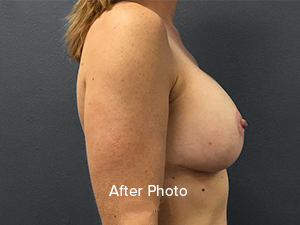 Breast Lift