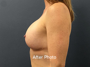 Breast Lift