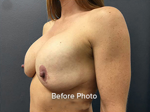 Breast Lift