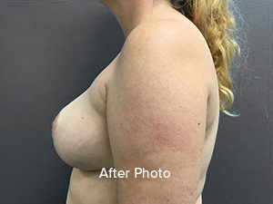 Breast Reduction