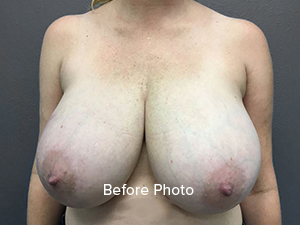 Breast Reduction