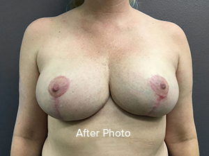 Breast Reduction