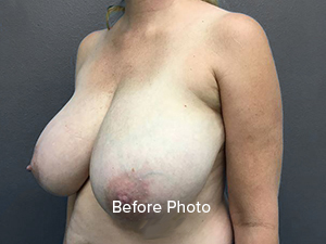 Breast Reduction