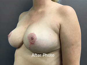 Breast Reduction