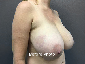 Breast Reduction