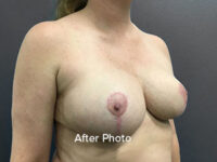 Breast Reduction