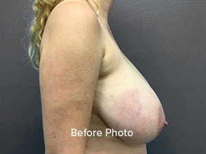 Breast Reduction