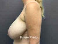 Breast Reduction