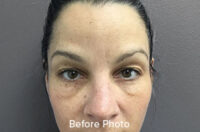 Browlift/Blepharoplasty