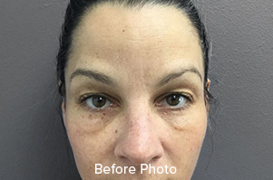 Browlift/Blepharoplasty