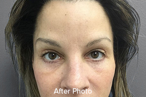 Browlift/Blepharoplasty