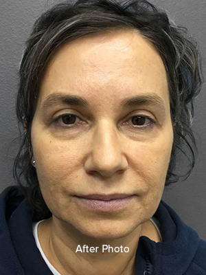 Browlift/Blepharoplasty