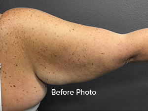 Before photo of arm highlighting skin texture and imperfections. Lentz Plastic Surgery.