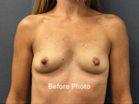 Breast Augmentation