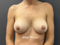 Breast Augmentation