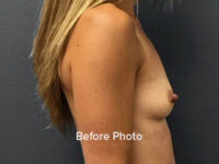 Breast Augmentation