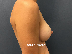 Breast Augmentation