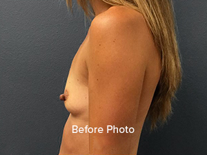 Breast Augmentation