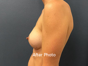 Breast Augmentation