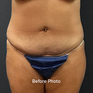 Tummy Tuck