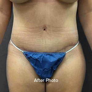 Tummy Tuck