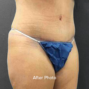 Tummy Tuck