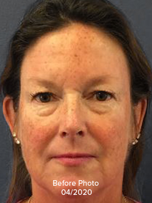 Face Reconstruction