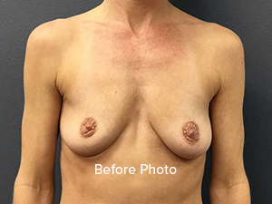 Breast Augmentation