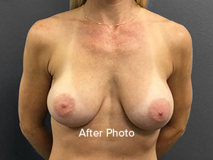 Breast Augmentation