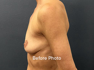 Breast Augmentation