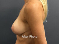 Breast Augmentation