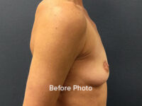 Breast Augmentation