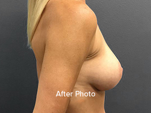 Breast Augmentation