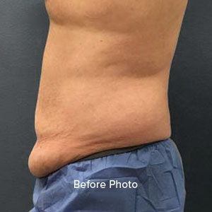 Tummy Tuck