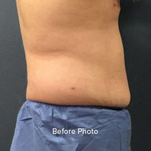 Tummy Tuck