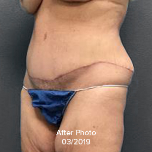 Tummy Tuck