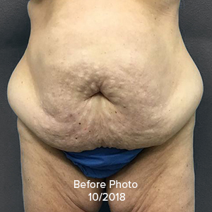 Tummy Tuck