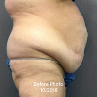 Tummy Tuck