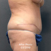 Tummy Tuck